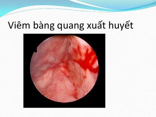 Viêm bàng quang xuất huyết